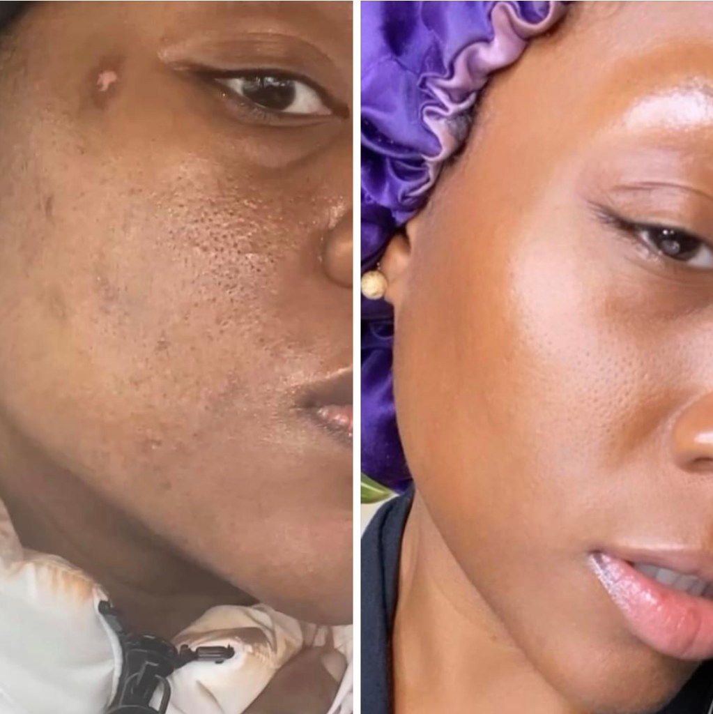 black woman acne